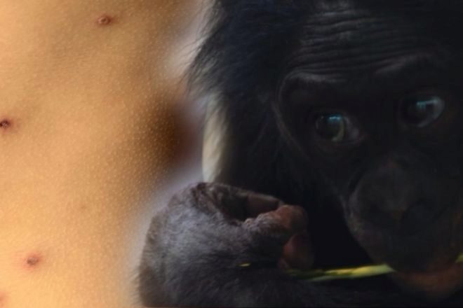 Cómo se contagia y cuáles son los síntomas de la viruela del mono