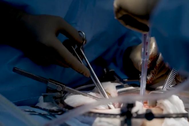 Cirujanos de Nueva York trasplantan un riñón de cerdo a un hombre con muerte cerebral