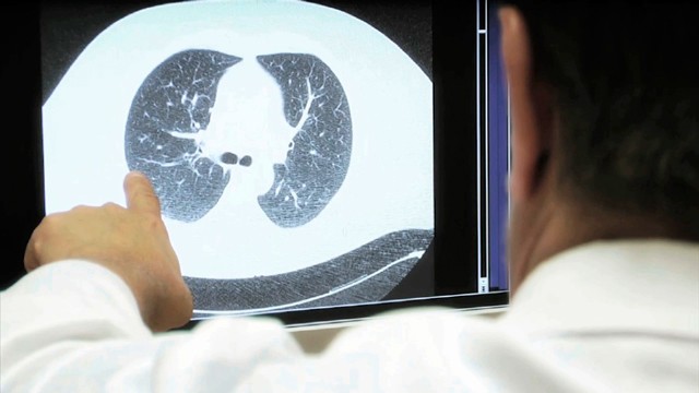Diagnstico precroz en el cncer de pulmn