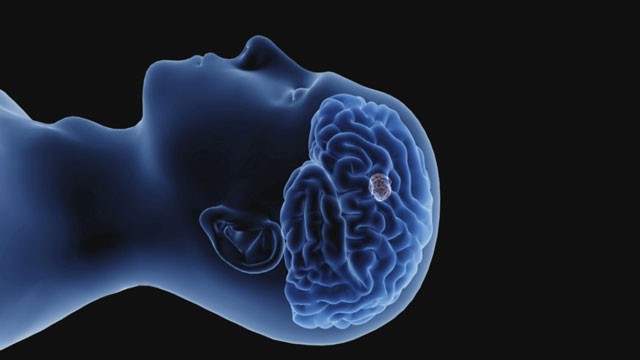 Primer ensayo clnico del mundo que trata el tumor cerebral ms agresivo